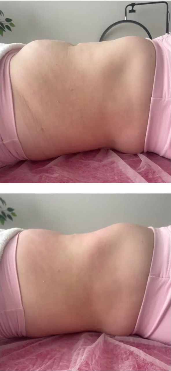 Antes e depois da região lombar e abdominal de outra aluna após uma sessão do protocolo neurovisceral