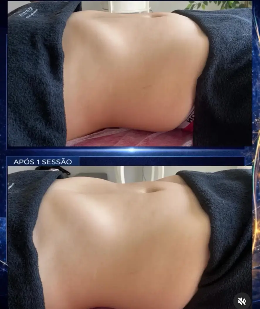 Antes e depois da região abdominal após uma sessão do protocolo neurovisceral